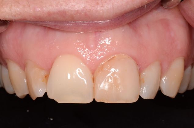 Porcelain Veneers: Case 15 - Before