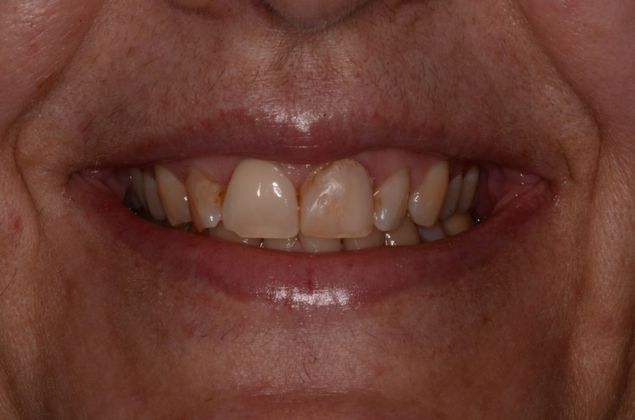 Porcelain Veneers: Case 15 - Before