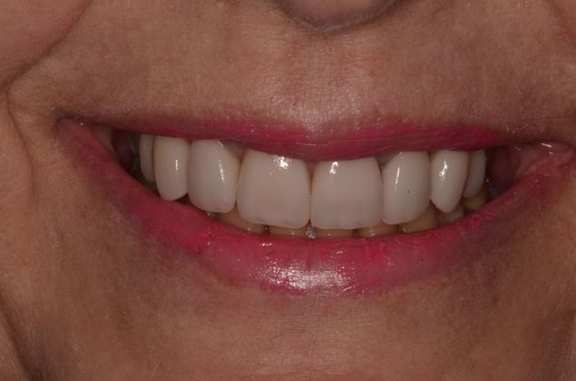 Porcelain Veneers: Case 15 - After