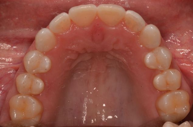 Invisalign: Case 6 - After