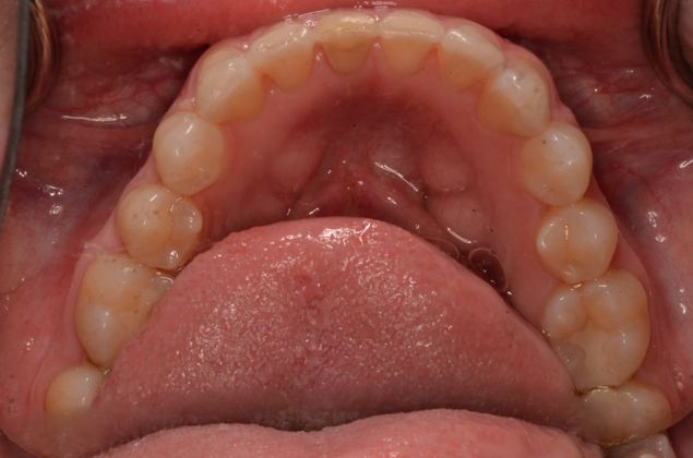 Invisalign: Case 6 - After