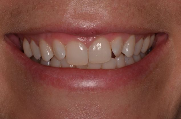 Invisalign: Case 6 - Before