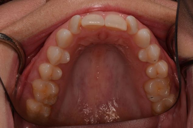 Invisalign: Case 6 - Before