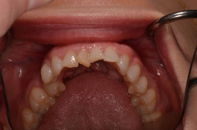 Invisalign: Case 6 - Before