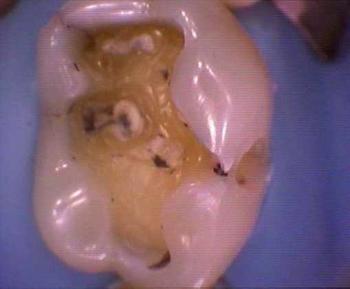 Cerec Case 4 - Before