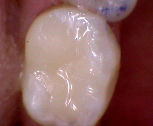 Cerec Case 4 - After