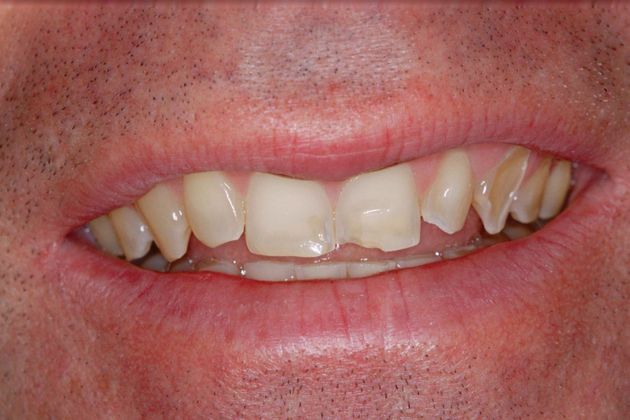 Porcelain Veneers: Mike - Before