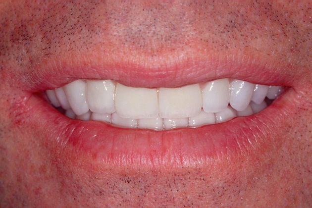Porcelain Veneers: Mike - After