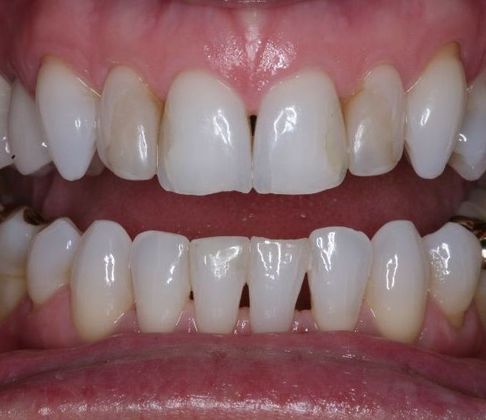 Porcelain Veneers: Jan - Before