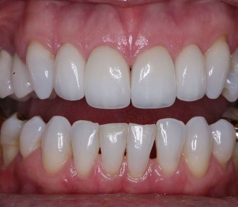 Porcelain Veneers: Jan - After