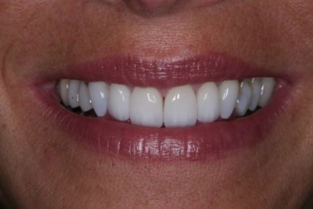 Porcelain Veneers: Jan - After