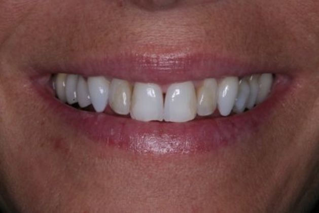 Porcelain Veneers: Jan - Before