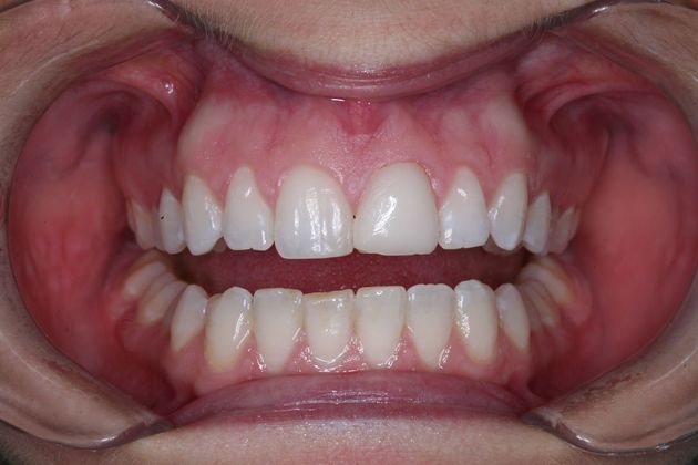 Porcelain Veneers: Kym - Before