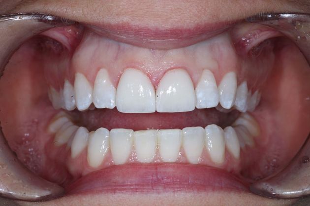 Porcelain Veneers: Kym - After