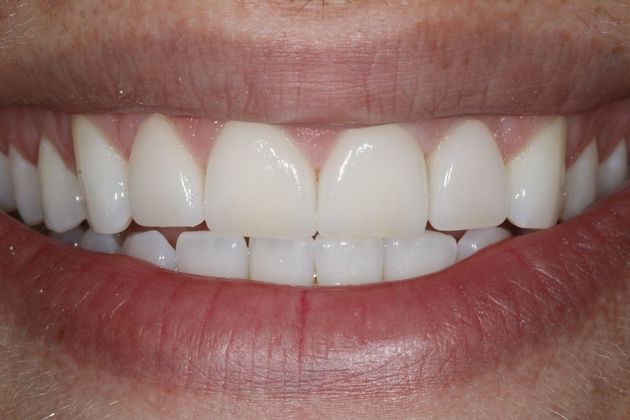 Porcelain Veneers:  Bill - After