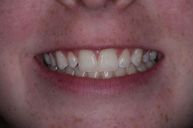 Dental Bonding:  Emily - Before