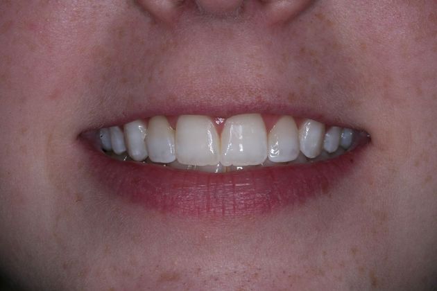 Dental Bonding:  Emily - After