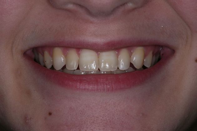 Dental Bonding: Kathy - Before