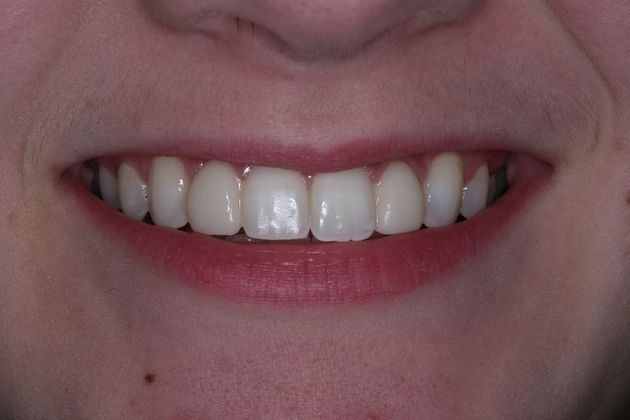 Dental Bonding: Kathy - After