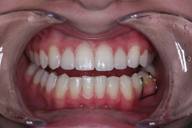 Dental Bonding: Kathy - After