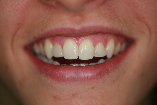 Smile Makeover: Ashley - Before