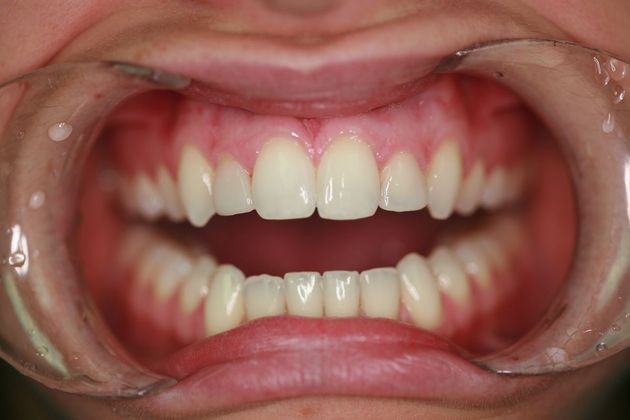 Smile Makeover: Ashley - Before