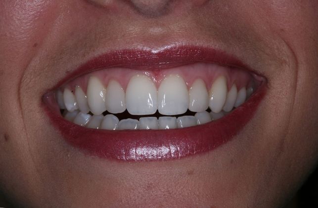 Smile Makeover: Ashley - After