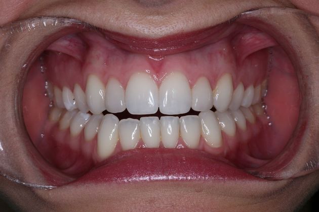 Smile Makeover: Ashley - After