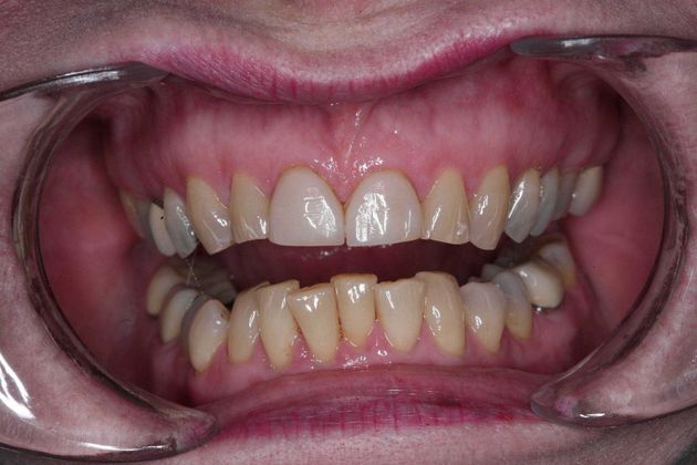 Smile Makeover: Ruth - Before