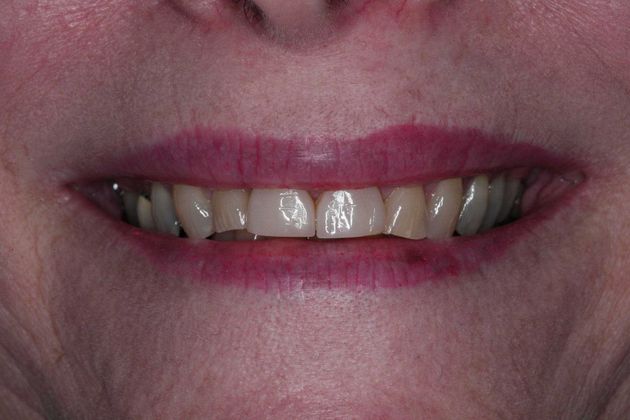 Smile Makeover: Ruth - Before