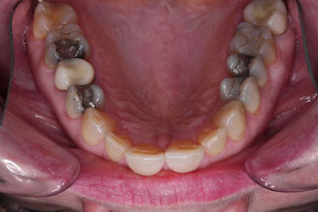 Smile Makeover: Ruth - Before