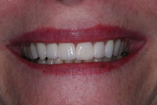 Smile Makeover: Ruth - After