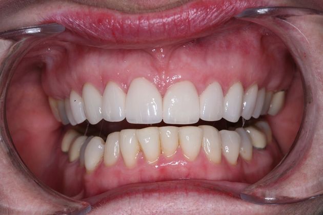 Smile Makeover: Ruth - After