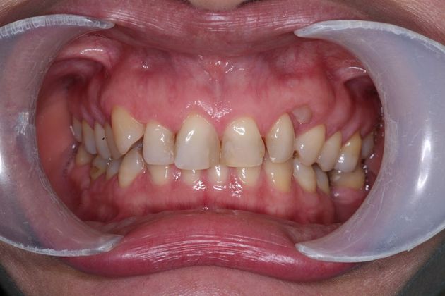 Smile Makeover: Suni - Before