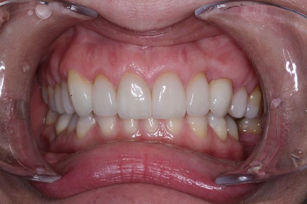 Smile Makeover: Suni - After