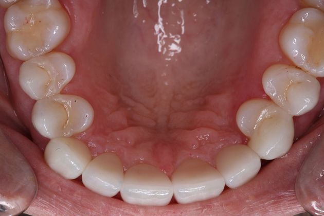 Smile Makeover: Suni - After