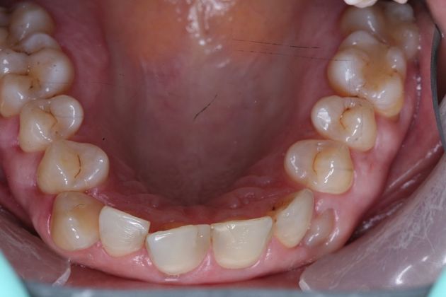 Smile Makeover: Suni - Before