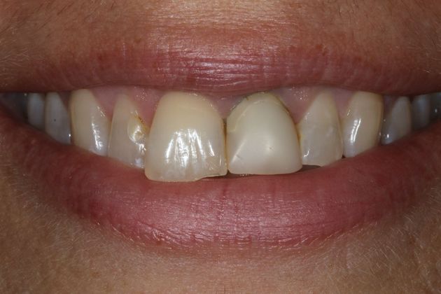 Smile Makeover: Rondelle - Before