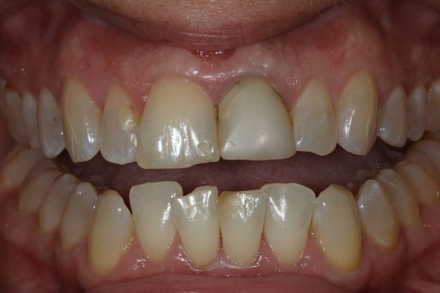 Smile Makeover: Rondelle - Before