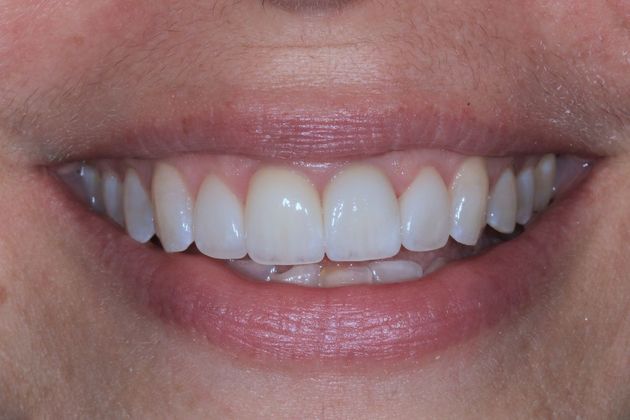 Smile Makeover: Rondelle - After