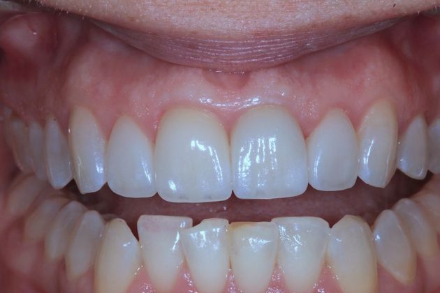 Smile Makeover: Rondelle - After