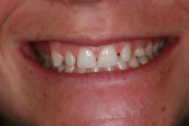 Implant Retained Crowns mary - Before