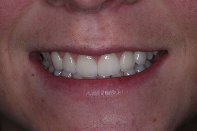 Implant Retained Crowns mary - After