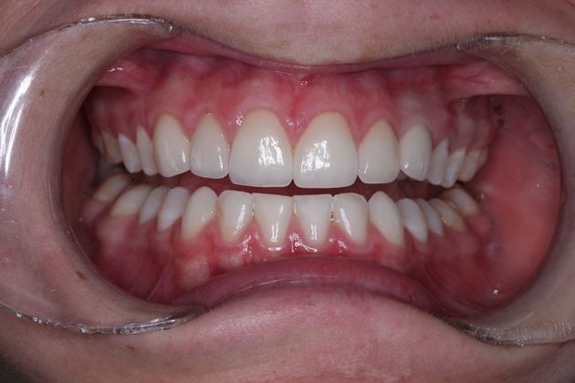 Implant Retained Crowns: mary - After