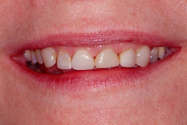 Full Mouth Rehabilitation: Susan - Before