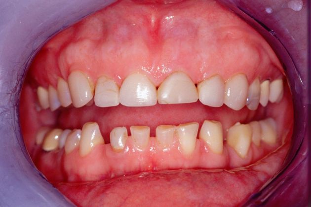 Full Mouth Rehabilitation: Susan - Before