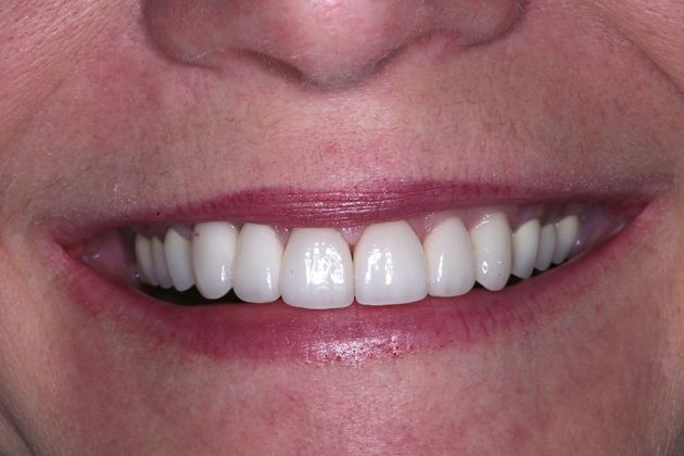 Full Mouth Rehabilitation: Susan - After