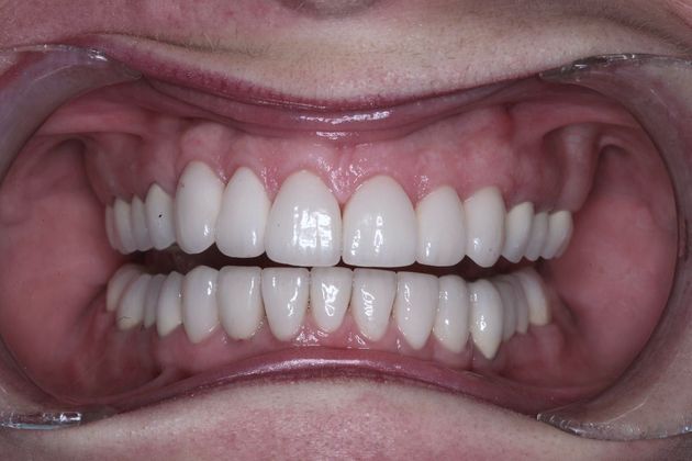 Full Mouth Rehabilitation: Susan - After