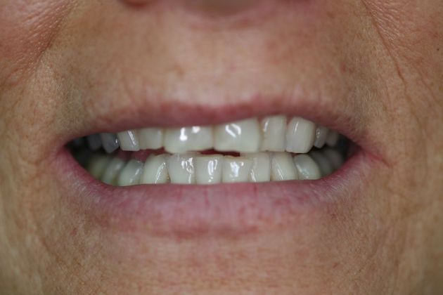 Full Mouth Rehabilitation: Mary - Before