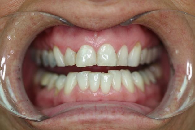 Full Mouth Rehabilitation: Mary - Before